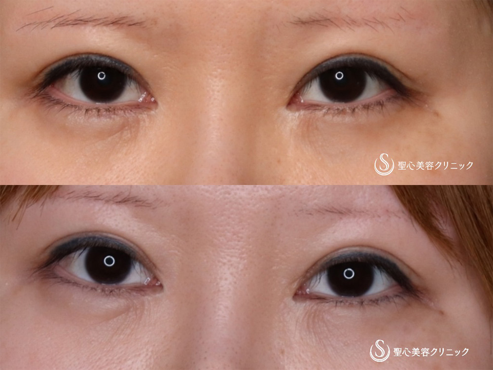 【30代女性・理想のミックス二重に】目上切開（2ヶ月後） After 