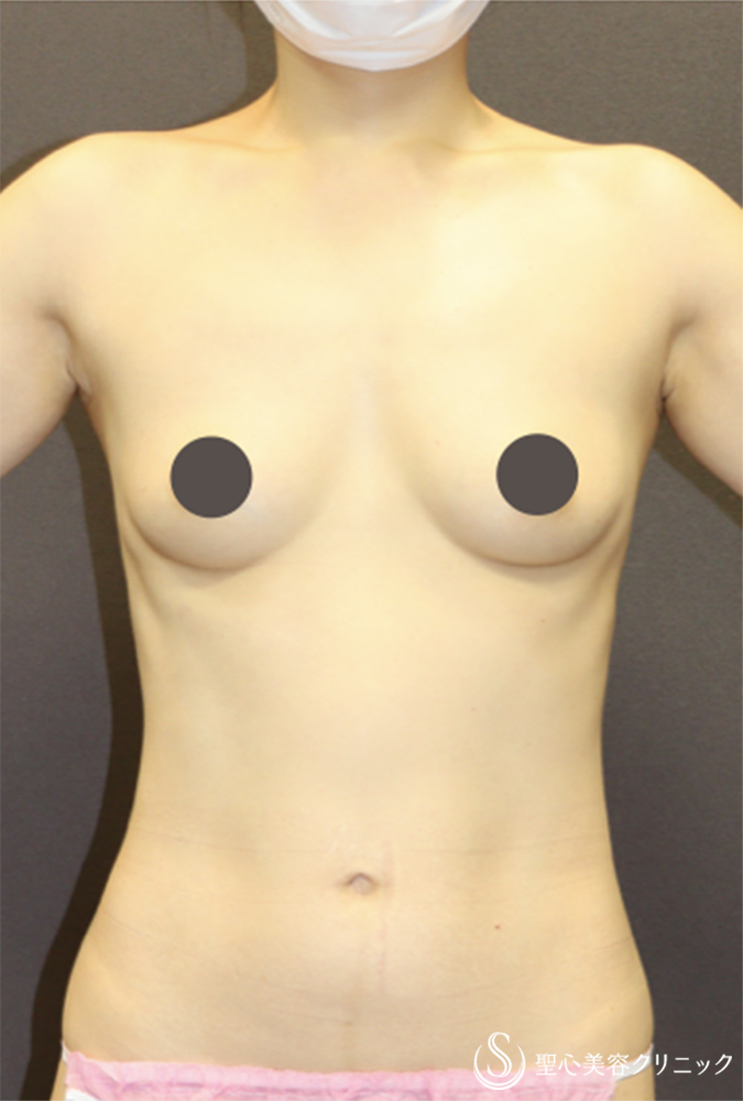 【40代女性・授乳前のバストに戻したい】プレミアムピュアグラフト豊胸術（3ヶ月後） Before 