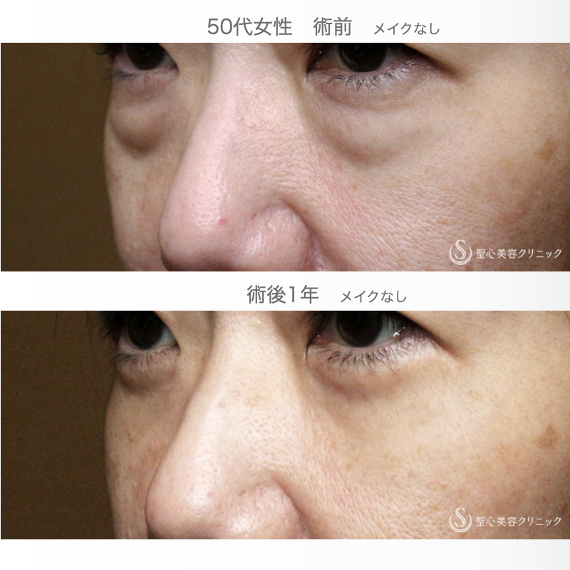 【50代女性・私が裏ハムラをしない理由】表ハムラ+α法「Ver.3」単独例（術直後〜1年後） After 