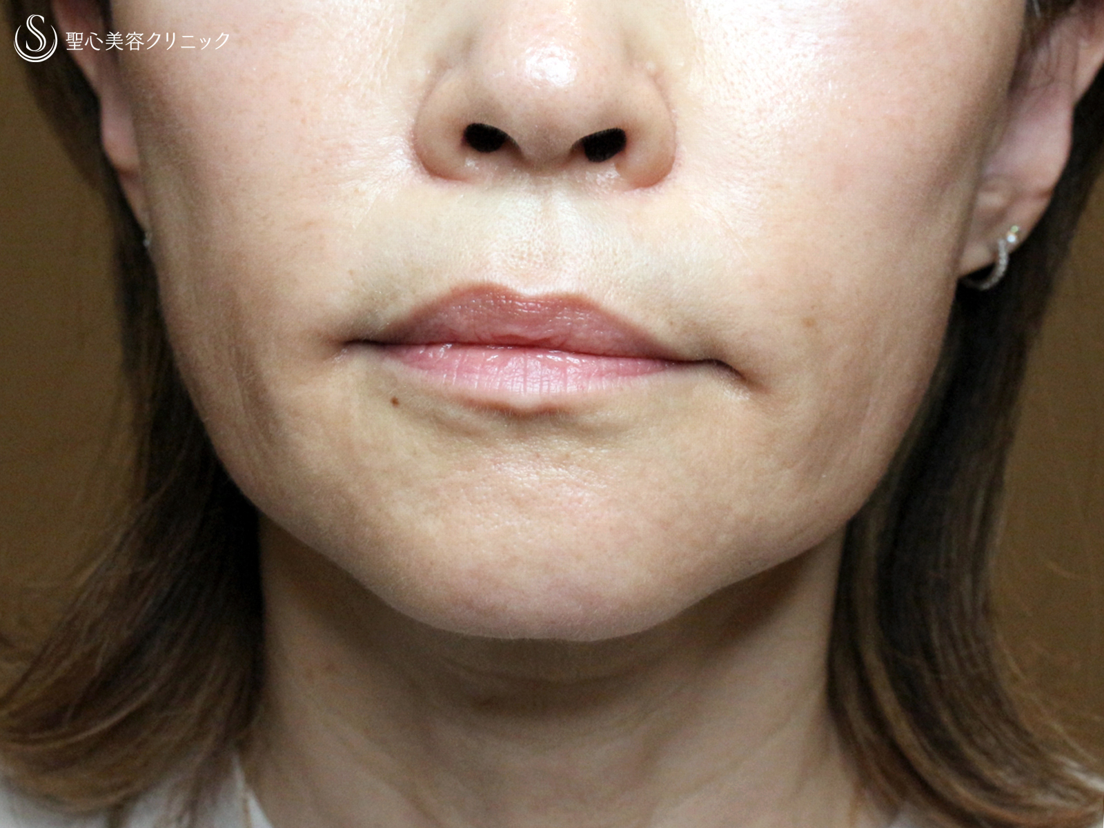 【60代女性・年齢を感じさせる「アゴの横じわ」】プレミアムPRP皮膚再生療法（10ヶ月後） After 
