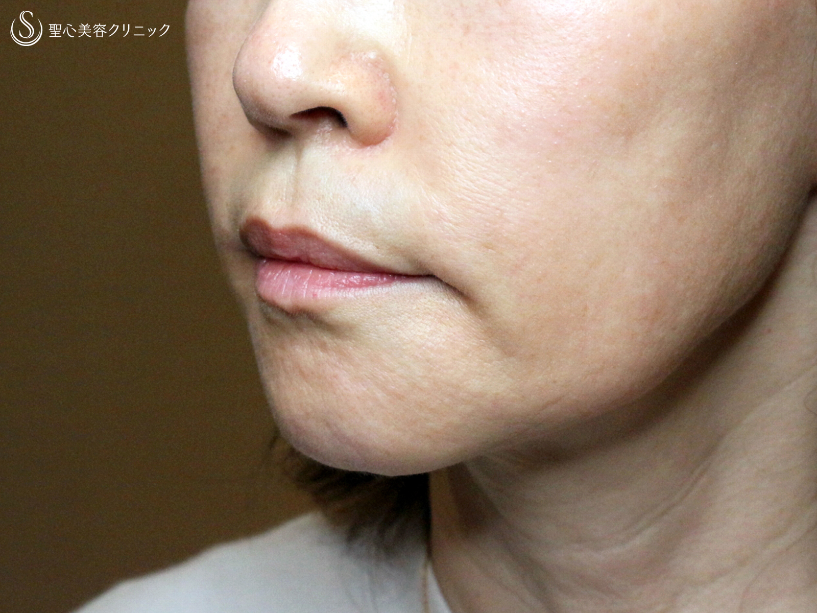 【60代女性・年齢を感じさせる「アゴの横じわ」】プレミアムPRP皮膚再生療法（10ヶ月後） After 