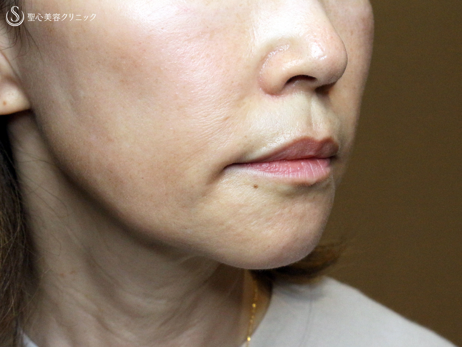 【60代女性・年齢を感じさせる「アゴの横じわ」】プレミアムPRP皮膚再生療法（10ヶ月後） After 