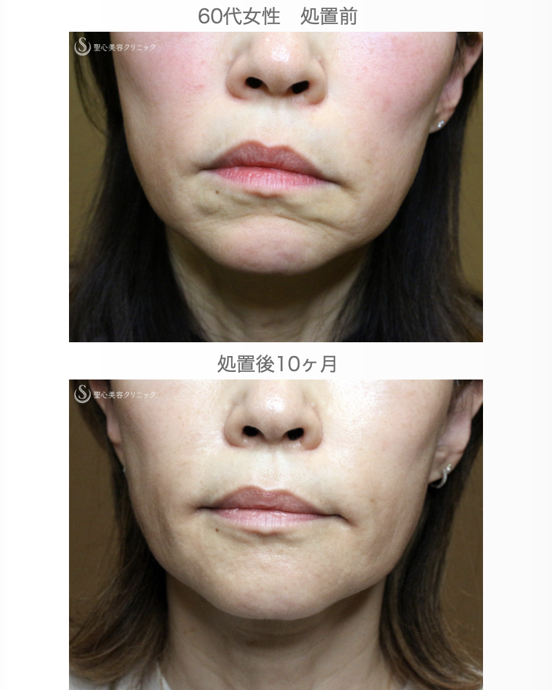 【60代女性・年齢を感じさせる「アゴの横じわ」】プレミアムPRP皮膚再生療法（10ヶ月後） After 