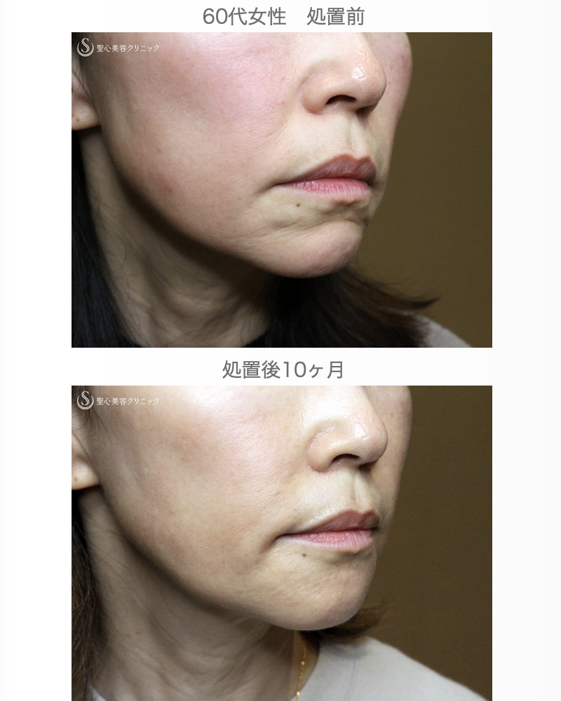 【60代女性・年齢を感じさせる「アゴの横じわ」】プレミアムPRP皮膚再生療法（10ヶ月後） After 