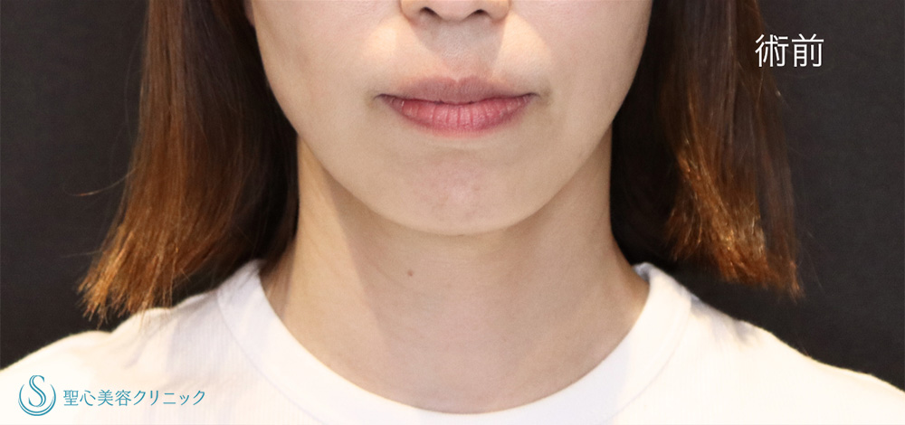 【40代女性・あごのヒアルロン酸でフェイスラインをシャープに】 ヒアルロン酸注入（あご）＋ボツリヌストキシン注入（注射）（1ヶ月後） Before 