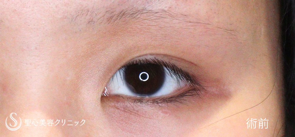 【20代女性・目を寄せずに蒙古襞のハリを解除】目上切開（1.5ヶ月後） Before 