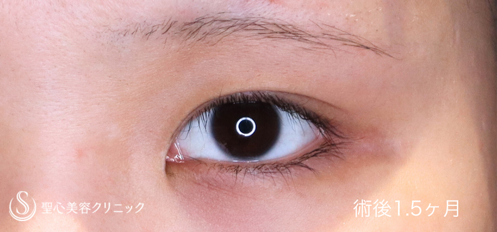 【20代女性・目を寄せずに蒙古襞のハリを解除】目上切開（1.5ヶ月後） After 
