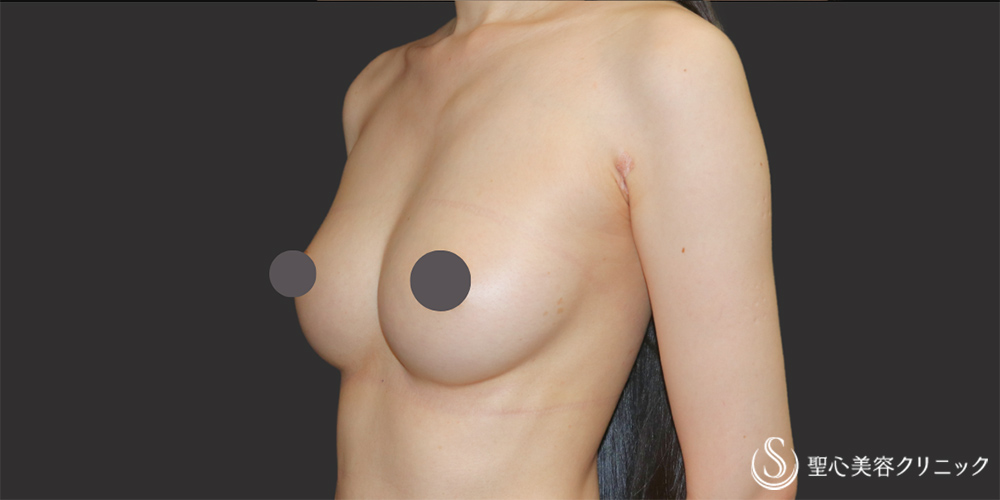 【30代女性・しっかりとボリュームアップ】プレミアムピュアグラフト豊胸術（2回）（1ヶ月後） After 