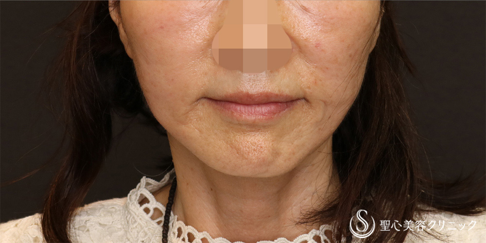 【60代女性・半永久的なリフトアップ】フェイスリフト＋脂肪吸引（頬＋顎）（3ヶ月後） After 