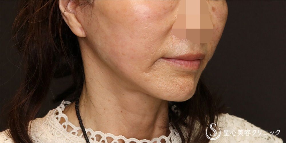 【60代女性・半永久的なリフトアップ】フェイスリフト＋脂肪吸引（頬＋顎）（3ヶ月後） After 