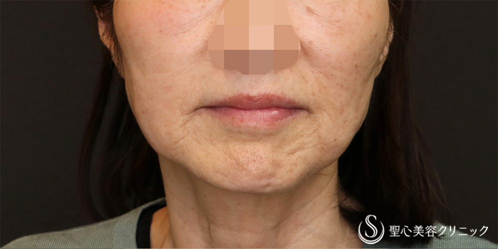 【60代女性・半永久的なリフトアップ】フェイスリフト＋脂肪吸引（頬＋顎）（3ヶ月後） Before 