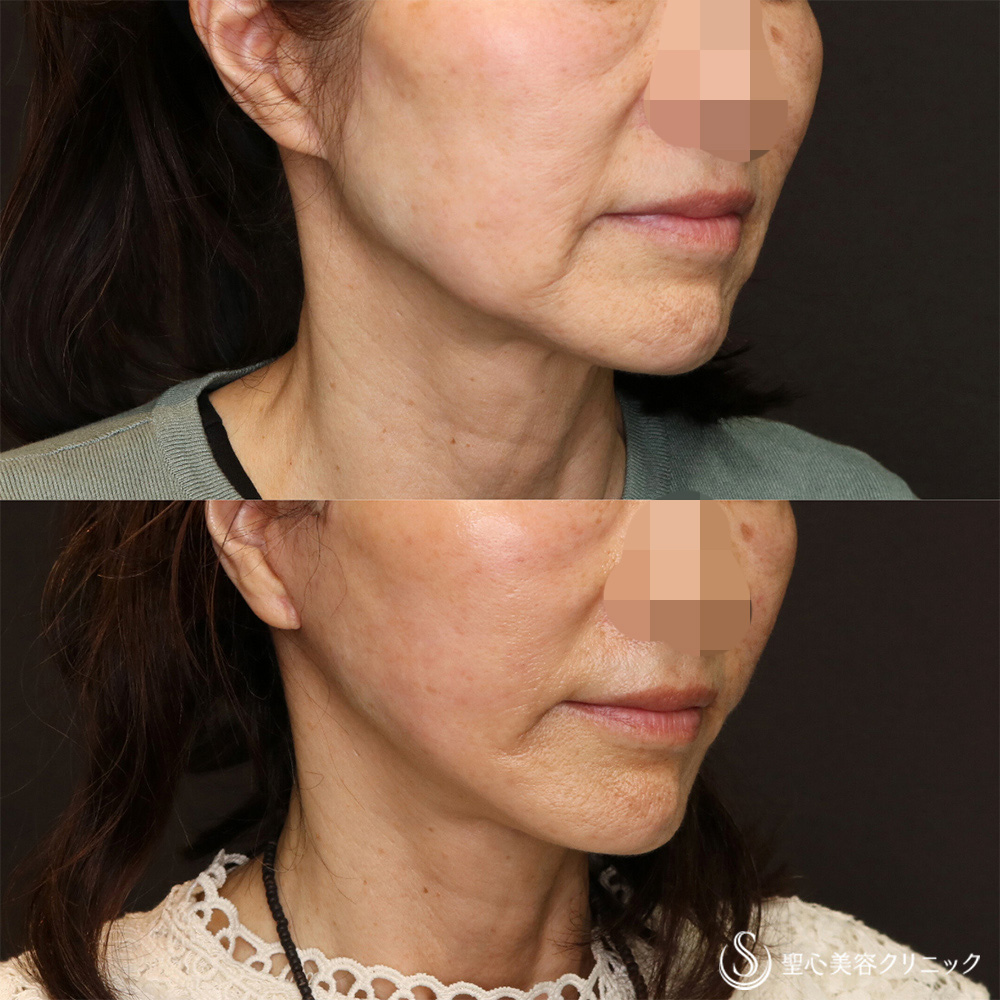 【60代女性・半永久的なリフトアップ】フェイスリフト＋脂肪吸引（頬＋顎）（3ヶ月後） After 名古屋院・リフトアップ・顔のたるみ