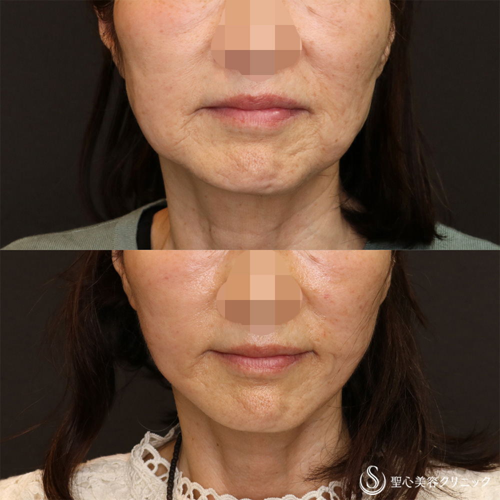 【60代女性・半永久的なリフトアップ】フェイスリフト＋脂肪吸引（頬＋顎）（3ヶ月後） After 名古屋院・リフトアップ・顔のたるみ