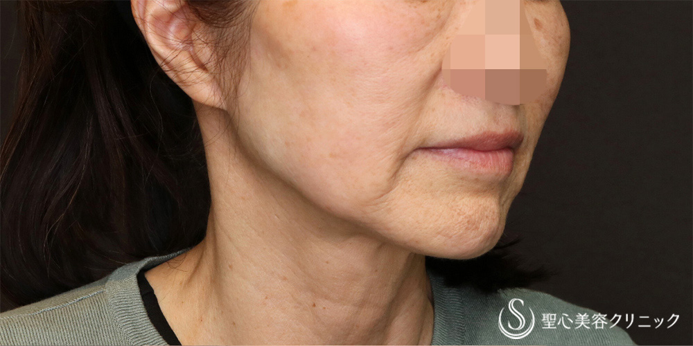 【60代女性・半永久的なリフトアップ】フェイスリフト＋脂肪吸引（頬＋顎）（3ヶ月後） Before 