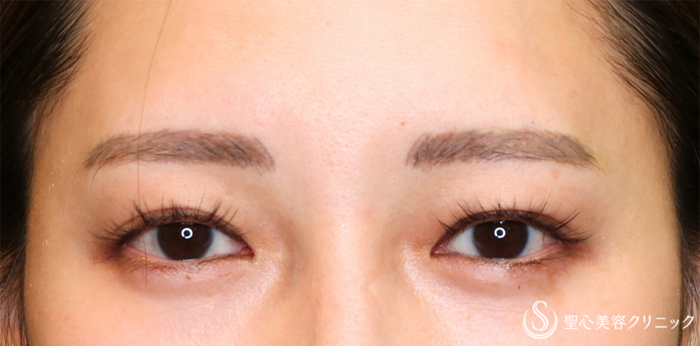 【20代女性・目の上を自然にすっきり】眉下切開法（眉下リフト）（1ヶ月後） Before 