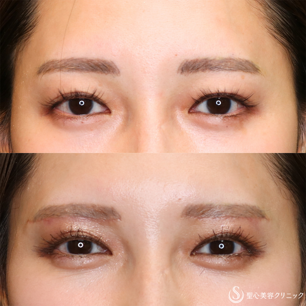 【20代女性・目の上を自然にすっきり】眉下切開法（眉下リフト）（1ヶ月後） After 名古屋・ぱっちり二重・平行型二重