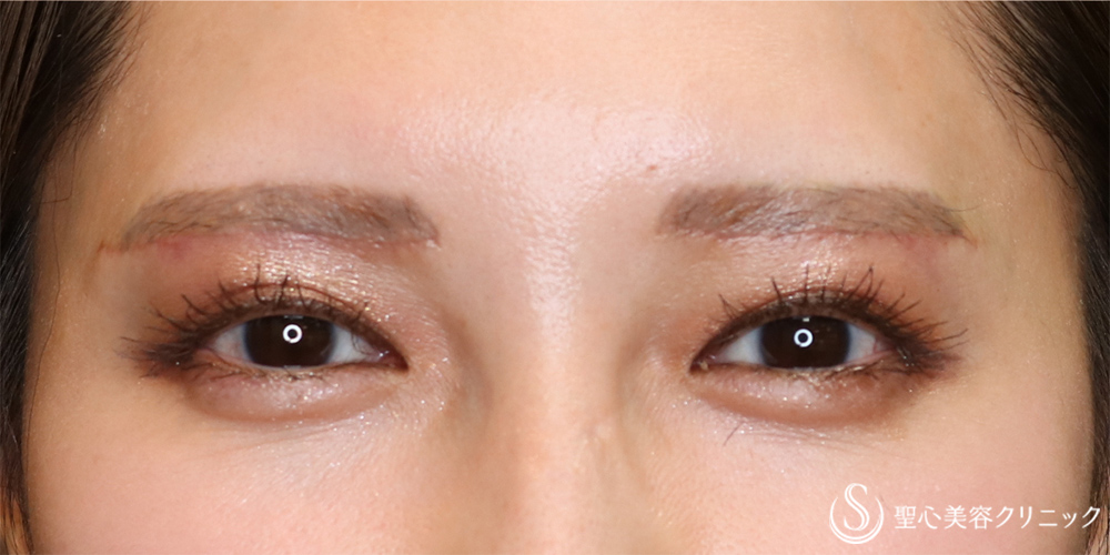 【20代女性・目の上を自然にすっきり】眉下切開法（眉下リフト）（1ヶ月後） After 