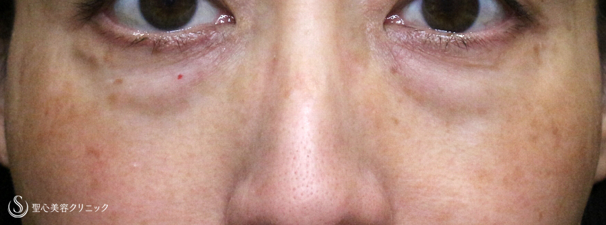 【50代女性・目の下だけで驚きの若返り効果】表ハムラ+α法「Ver.3」単独例（1年2ヶ月後） Before 