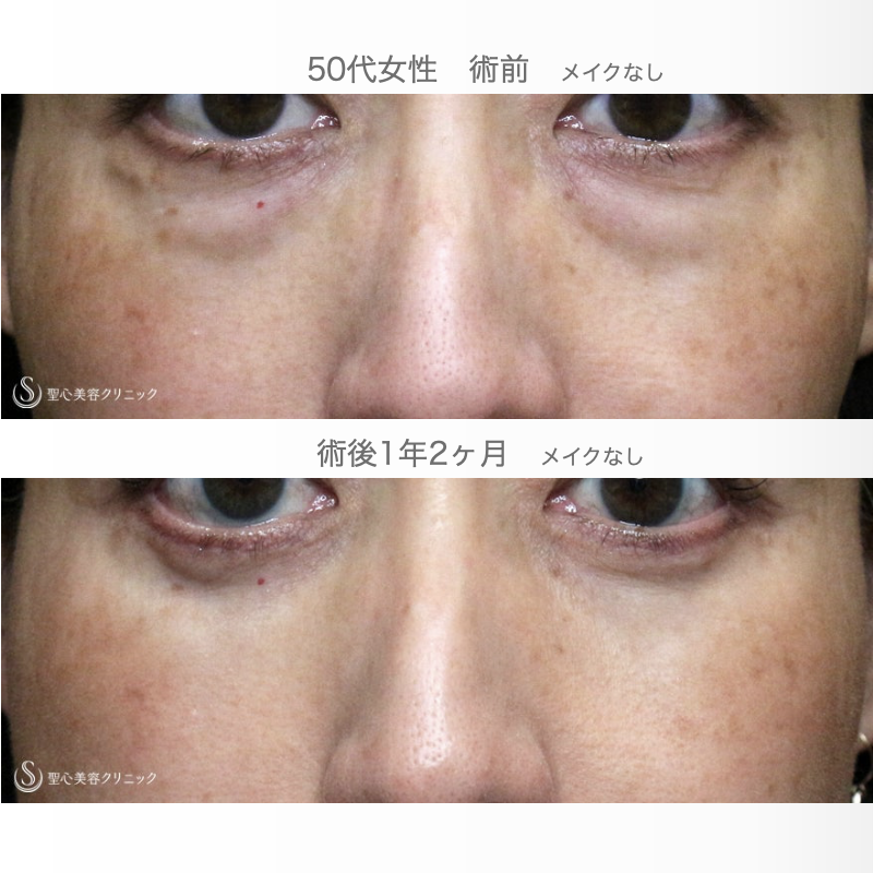 【50代女性・目の下だけで驚きの若返り効果】表ハムラ+α法「Ver.3」単独例（1年2ヶ月後） After 