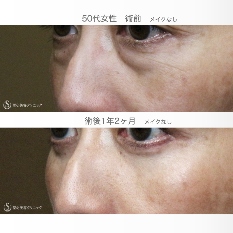 【50代女性・目の下だけで驚きの若返り効果】表ハムラ+α法「Ver.3」単独例（1年2ヶ月後） After 