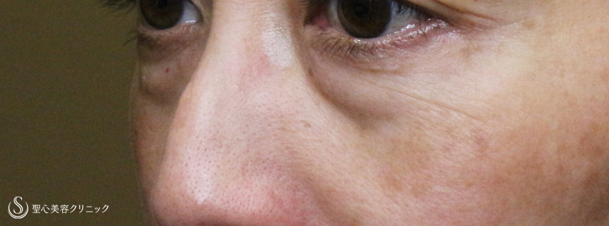 【50代女性・目の下だけで驚きの若返り効果】表ハムラ+α法「Ver.3」単独例（2ヶ月後） Before 