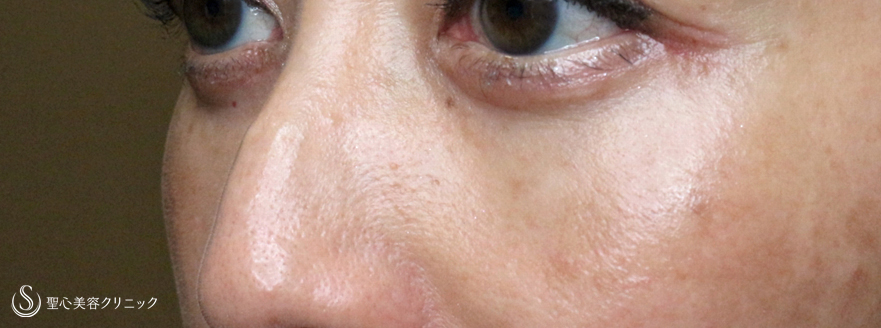 【50代女性・目の下だけで驚きの若返り効果】表ハムラ+α法「Ver.3」単独例（2ヶ月後） After 
