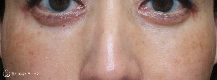 【50代女性・目の下だけで驚きの若返り効果】表ハムラ+α法「Ver.3」単独例（2ヶ月後） After 