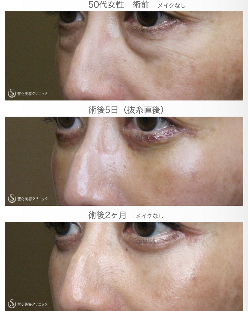 【50代女性・目の下だけで驚きの若返り効果】表ハムラ+α法「Ver.3」単独例（2ヶ月後） After 