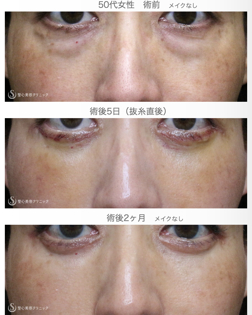 【50代女性・目の下だけで驚きの若返り効果】表ハムラ+α法「Ver.3」単独例（2ヶ月後） After 