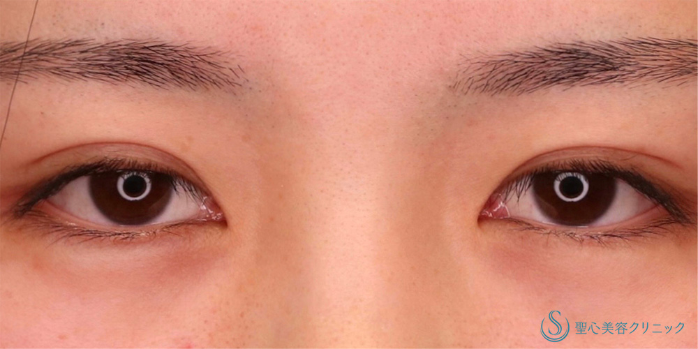 【20代女性・寄り目にさせず目頭側まで二重を入れたい&平行に近い二重にしたい】目上切開（1ヶ月後） Before 