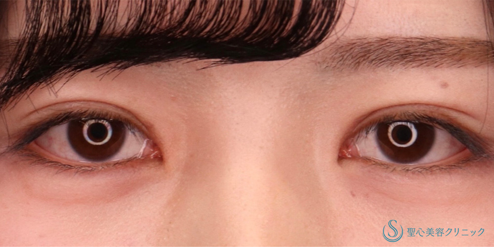 【20代女性・寄り目にさせず目頭側まで二重を入れたい&平行に近い二重にしたい】目上切開（1ヶ月後） After 