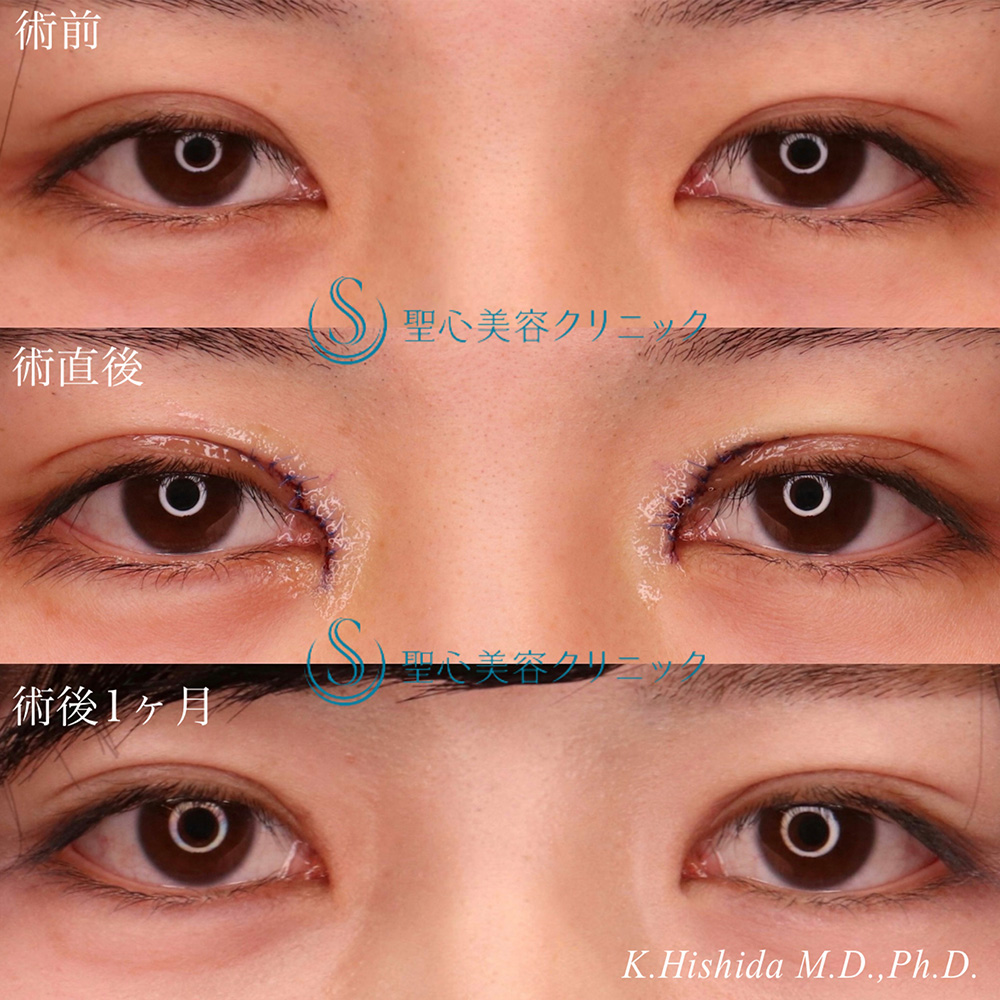 【20代女性・寄り目にさせず目頭側まで二重を入れたい&平行に近い二重にしたい】目上切開（1ヶ月後） After 