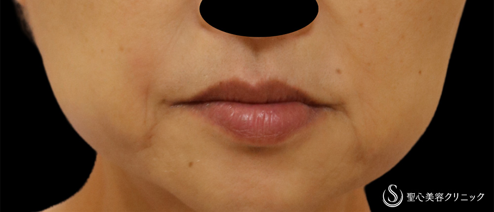 【50代女性・目の下＋ほうれい線4年後もきれいを持続】 プレミアムPRP皮膚再生療法（4年後） After 