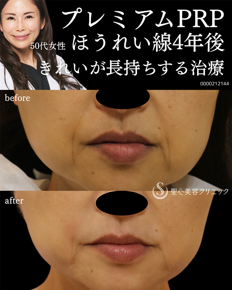 【50代女性・目の下＋ほうれい線4年後もきれいを持続】 プレミアムPRP皮膚再生療法（4年後） After 