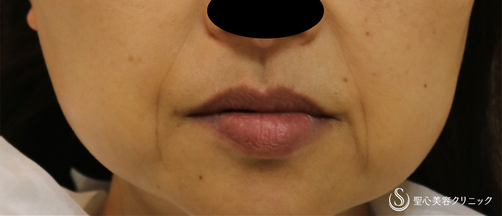 【50代女性・目の下＋ほうれい線4年後もきれいを持続】 プレミアムPRP皮膚再生療法（4年後） Before 