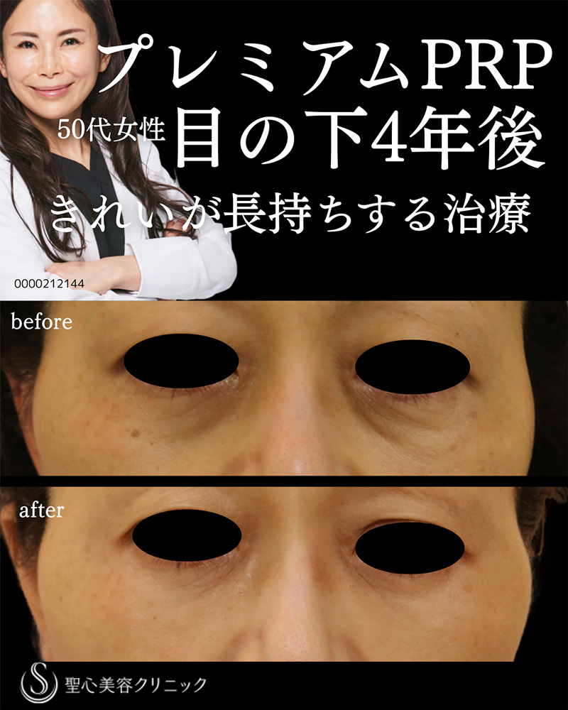 【50代女性・目の下＋ほうれい線4年後もきれいを持続】 プレミアムPRP皮膚再生療法（4年後） After 