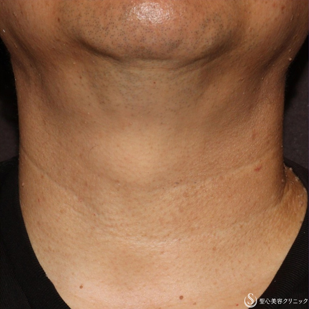 【50代男性・首のいぼ（アクロコルドン＋スキンタッグ）治療】炭酸ガスレーザー（CO2レーザー）（1ヶ月後） After 