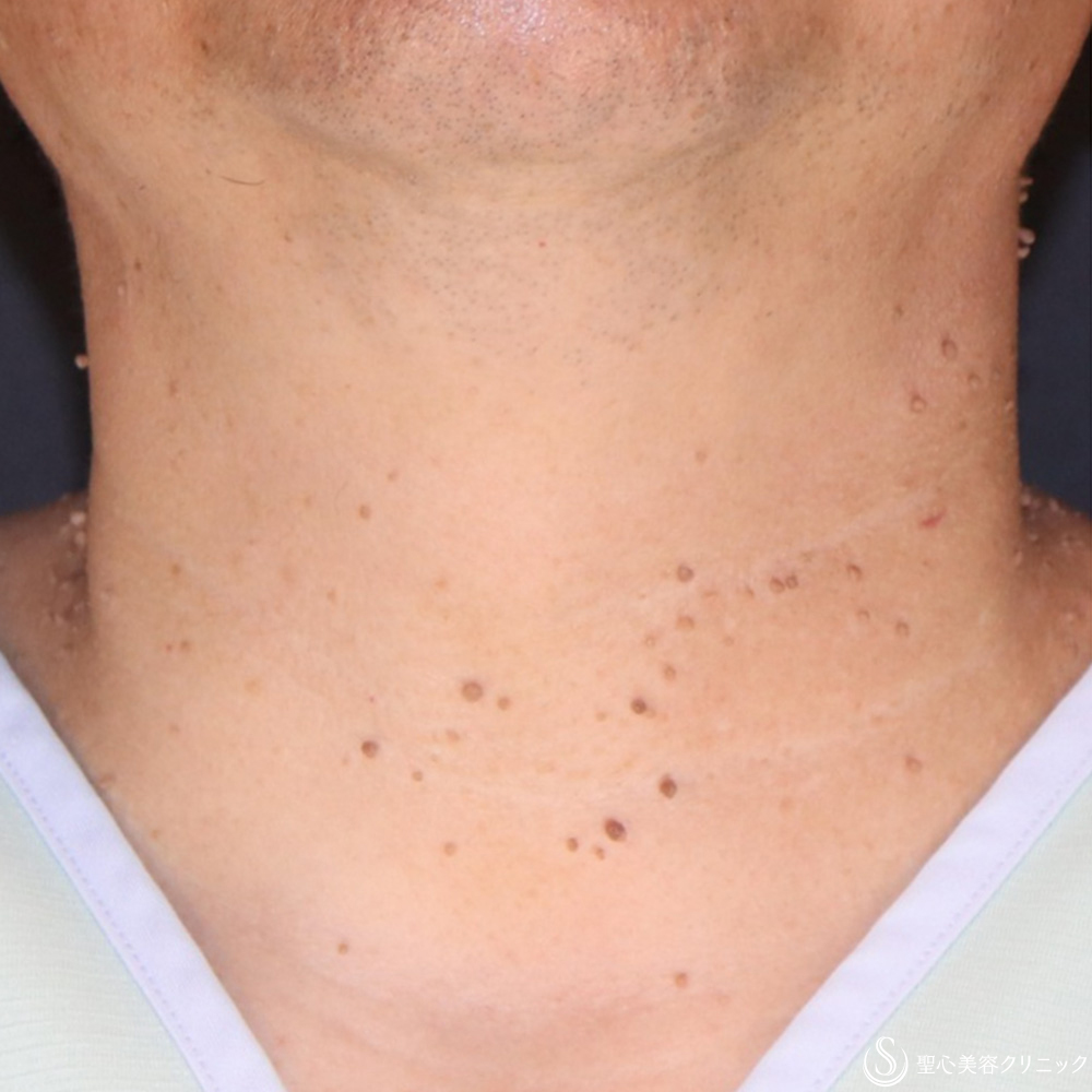 【50代男性・首のいぼ（アクロコルドン＋スキンタッグ）治療】炭酸ガスレーザー（CO2レーザー）（1ヶ月後） Before 