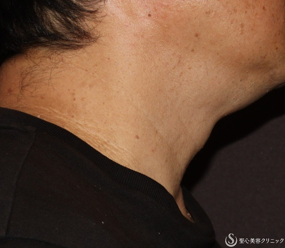 【50代男性・首のいぼ（アクロコルドン＋スキンタッグ）治療】炭酸ガスレーザー（CO2レーザー）（1ヶ月後） After 