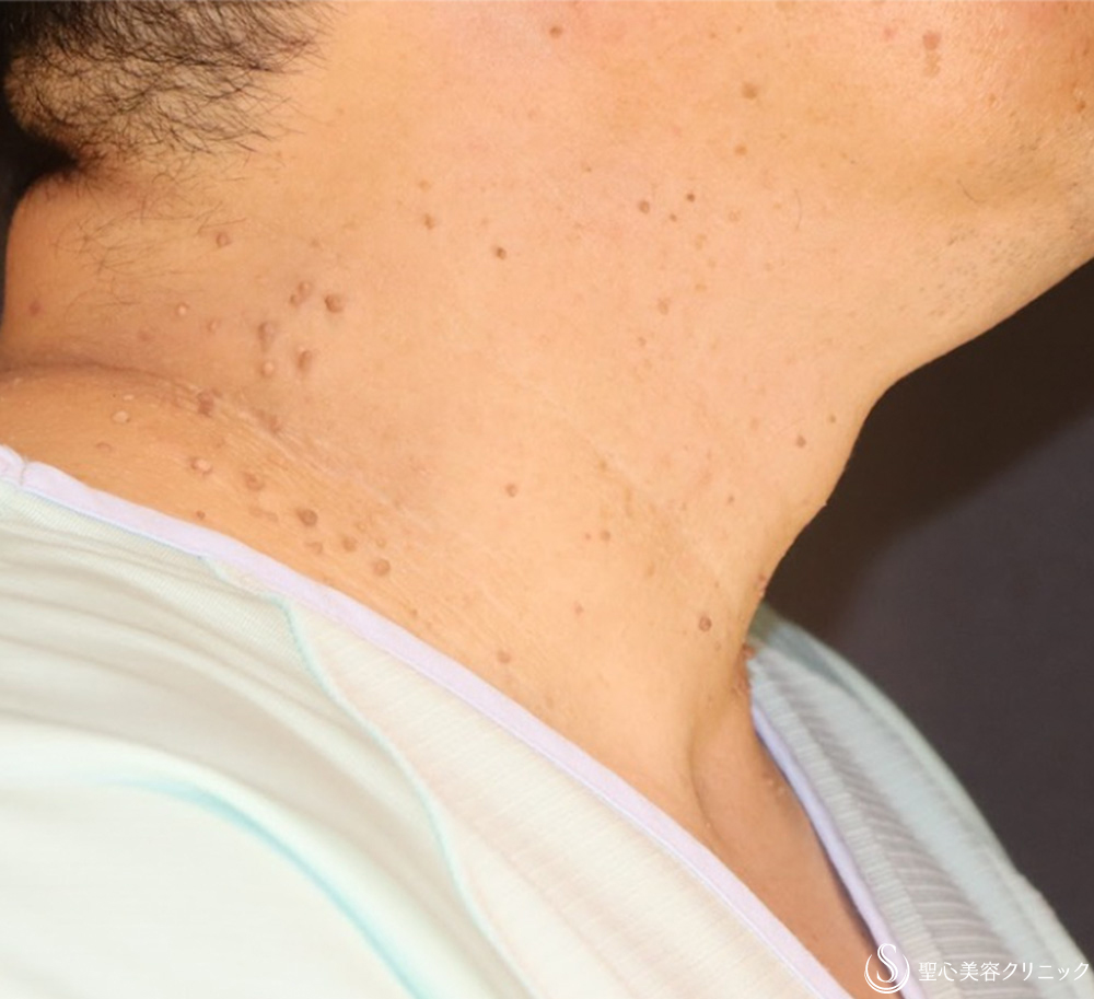 【50代男性・首のいぼ（アクロコルドン＋スキンタッグ）治療】炭酸ガスレーザー（CO2レーザー）（1ヶ月後） Before 