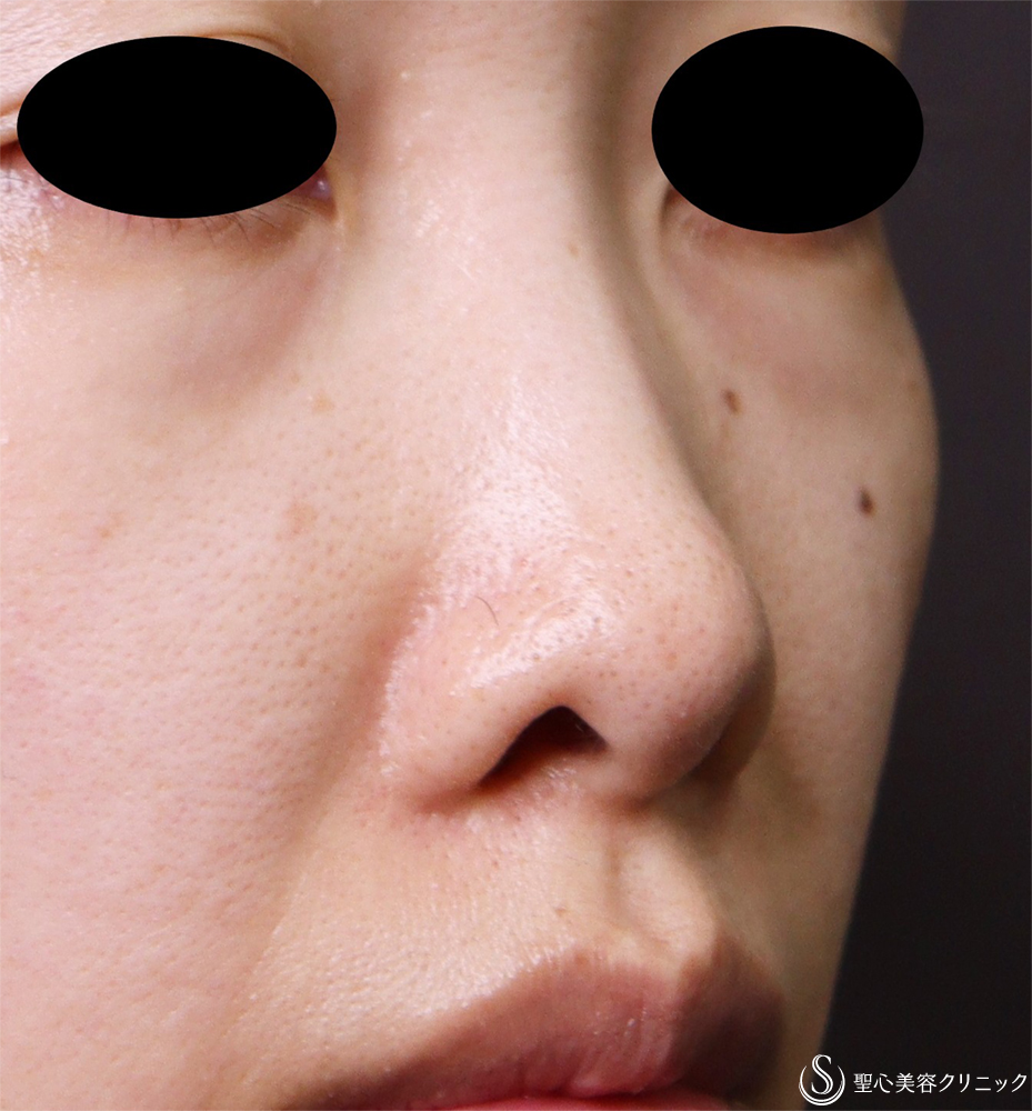 【30代女性・鼻孔のとがったような形を改善】鼻孔縁下降術（3週間後） Before 