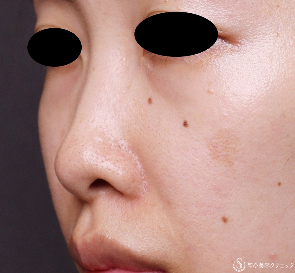 【30代女性・鼻孔のとがったような形を改善】鼻孔縁下降術（3週間後） Before 