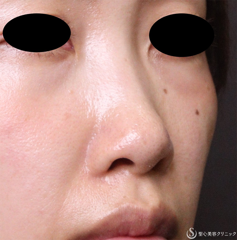 【30代女性・鼻孔のとがったような形を改善】鼻孔縁下降術（3週間後） After 