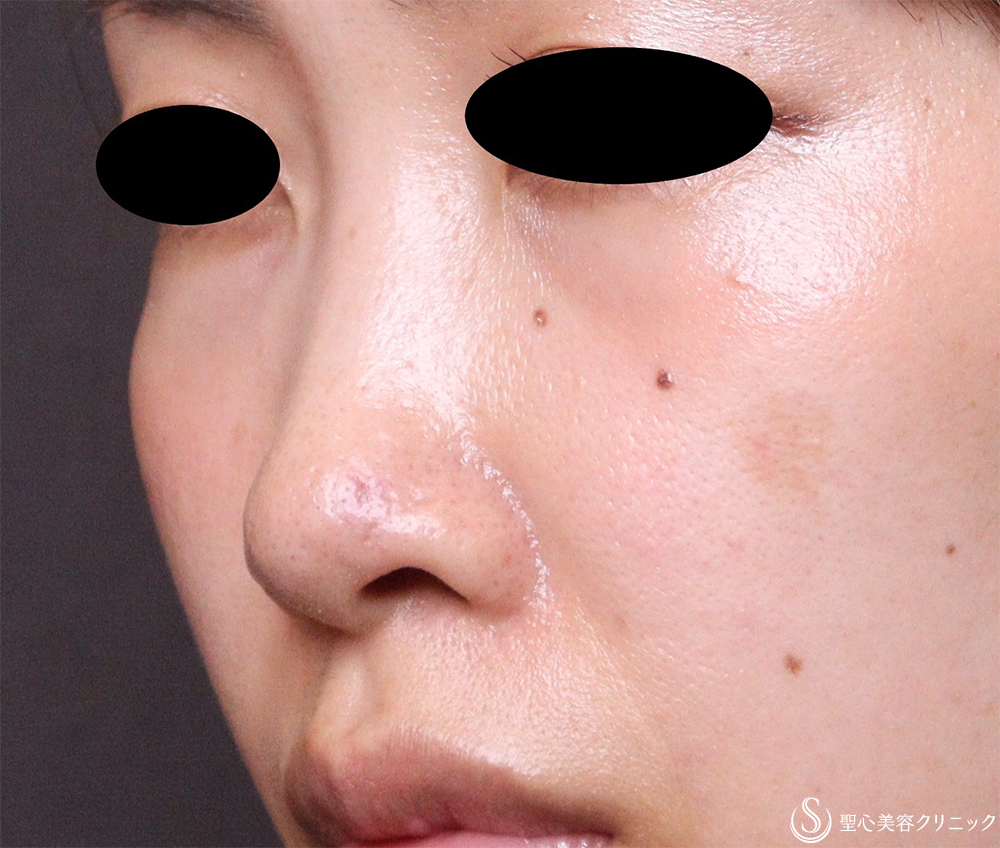 【30代女性・鼻孔のとがったような形を改善】鼻孔縁下降術（3週間後） After 