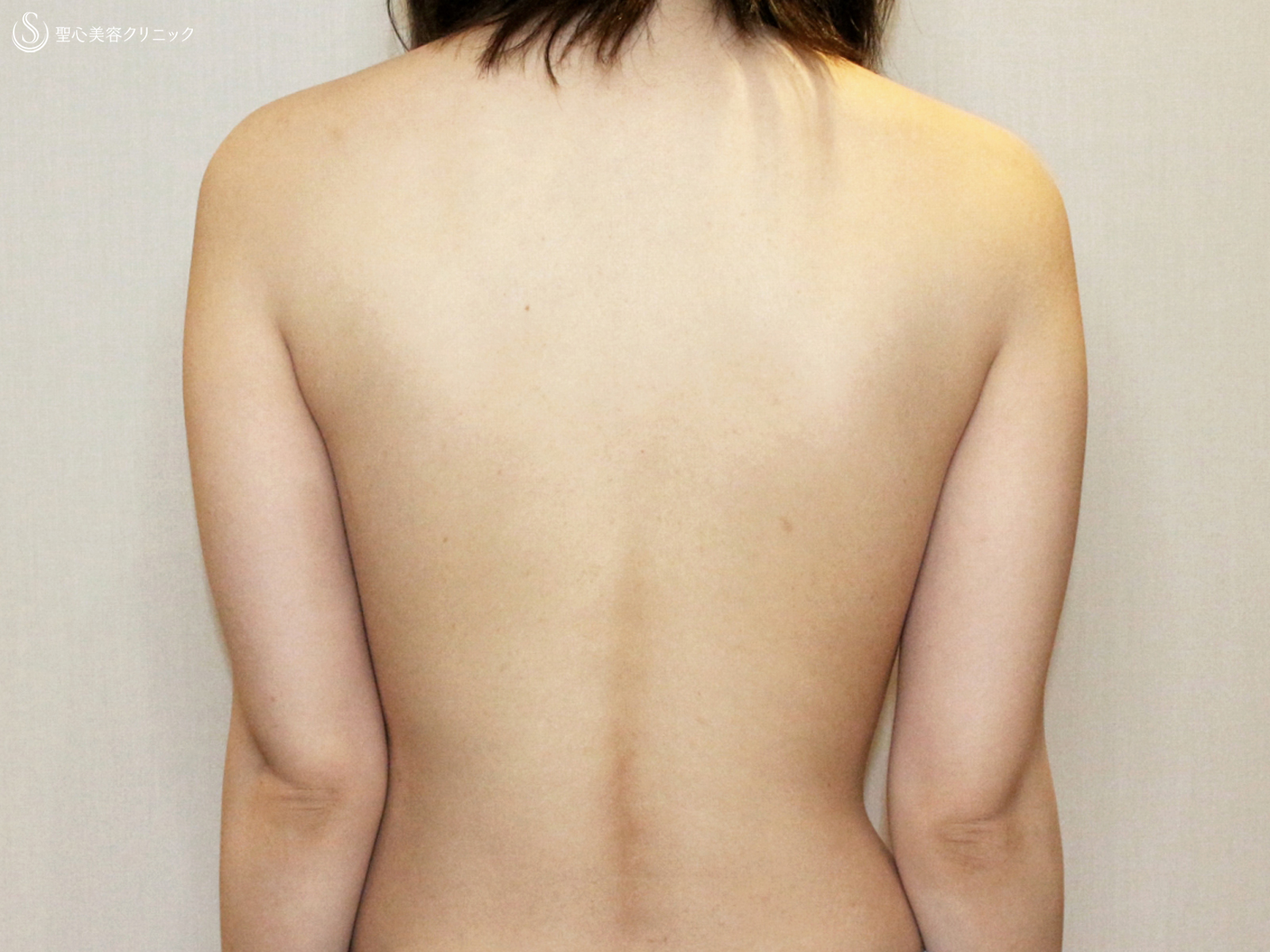 【20代女性・夏の「二の腕」のお悩み解消】ベイザー脂肪吸引（2年後） Before 