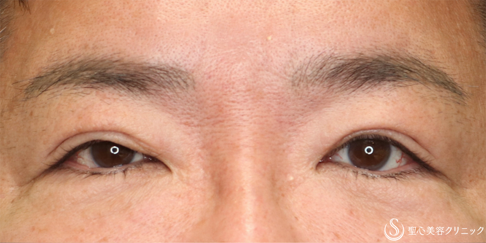 【50代男性・自然な二重幅へ】眼瞼下垂（切開法）（3ヶ月後） Before 