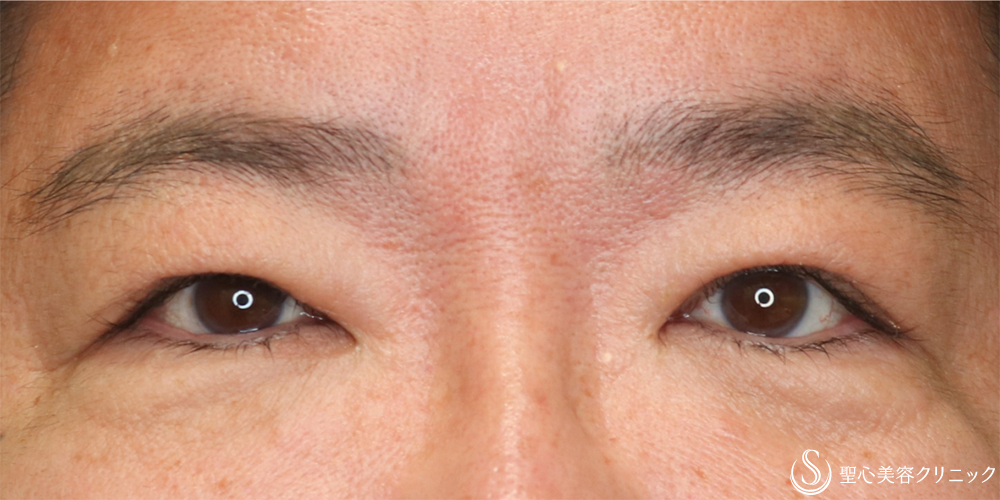 【50代男性・自然な二重幅へ】眼瞼下垂（切開法）（3ヶ月後） After 