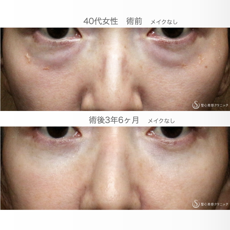 【40代女性・目の下のクマを切らずに解消】経結膜下脱脂術 単独（3年6ヶ月後） After 