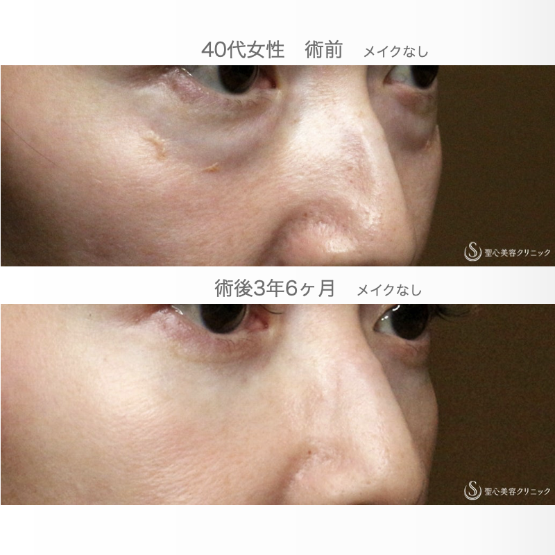 【40代女性・目の下のクマを切らずに解消】経結膜下脱脂術 単独（3年6ヶ月後） After 