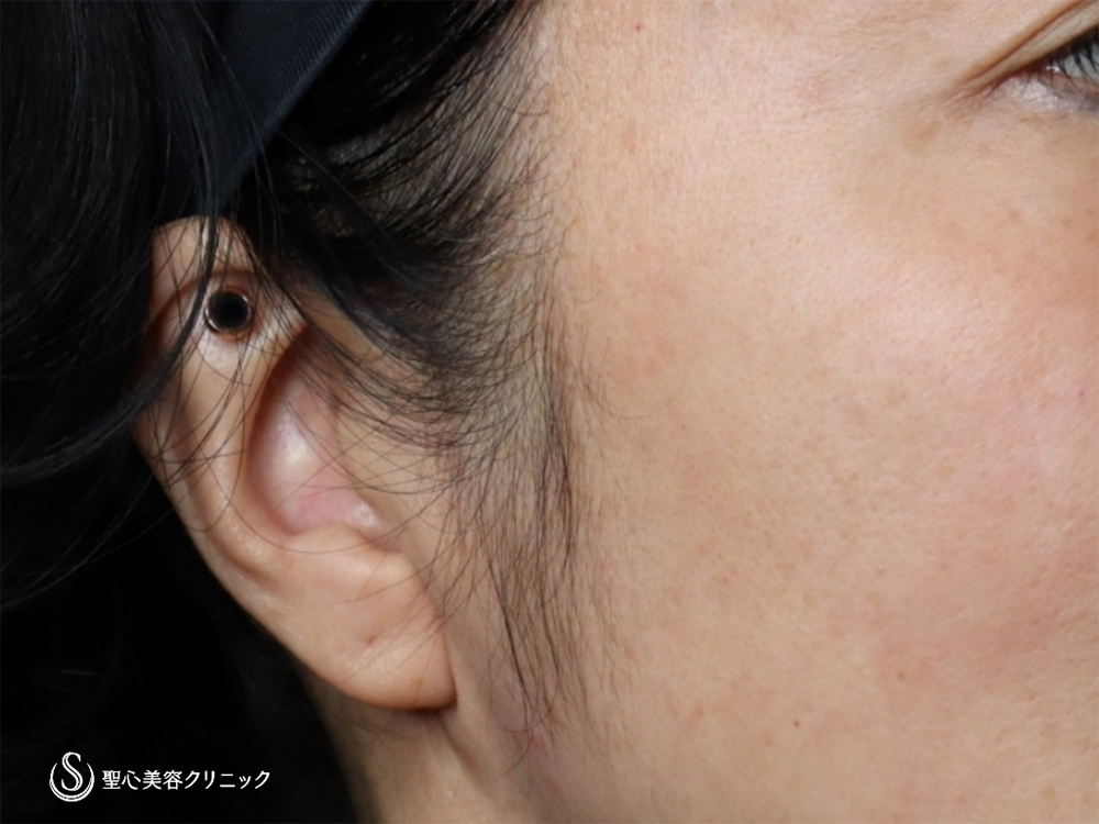 【40代女性・立ち耳にして小顔効果、可愛さアップ！！】立ち耳ヒアルロン酸（直後） Before 